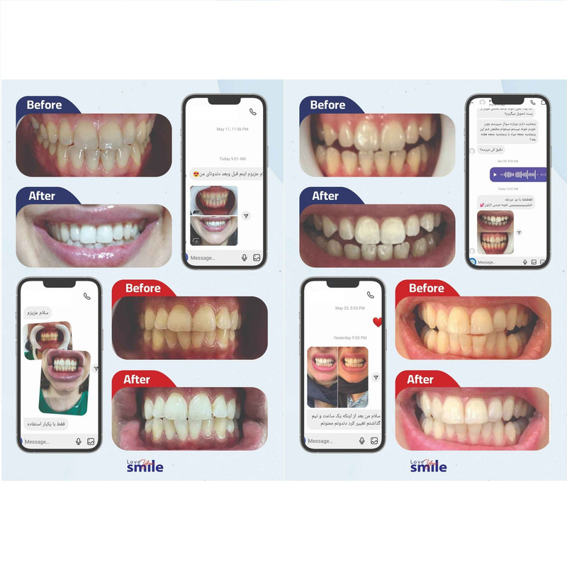 کیت بلیچینگ سفید کننده دندان خانگی دنتیلایت مدل Smile مجموعه 5 عددی