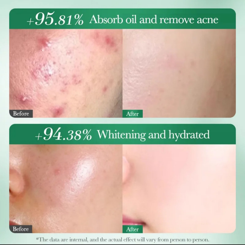 تونر پاککننده صورت سادور مدل ANTI-ACNE مناسب برای پوست آکنهای حجم 130 میلیلیتر
